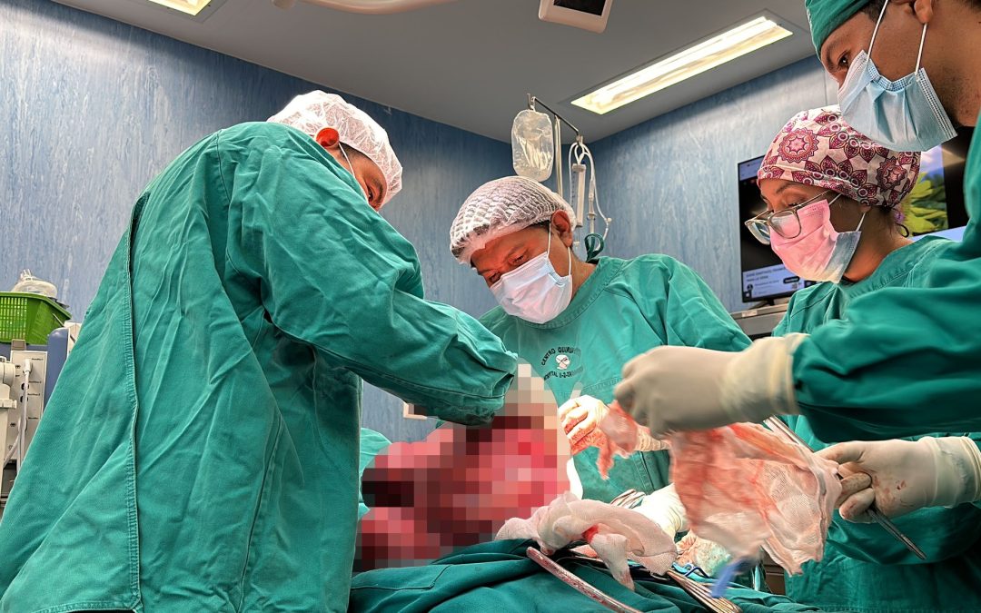 Médicos del Hospital Tarapoto extirpan gigantesco tumor de 15 kilos a mujer de 31 años